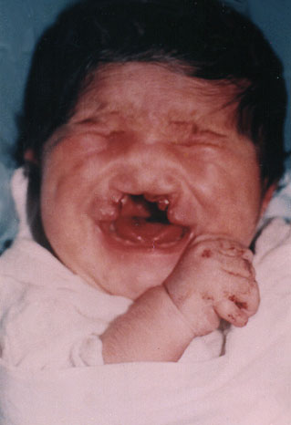 birth defects...