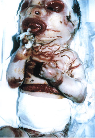birth defects...